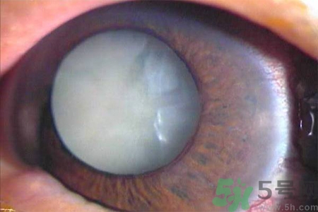 白內(nèi)障治療方法是什么？白內(nèi)障可以用什么藥物治療？