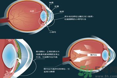 青光眼是什么？青光眼癥狀有什么？