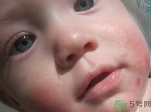 寶寶長(zhǎng)奶蘚怎么回事？寶寶長(zhǎng)奶蘚怎么辦？