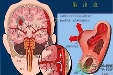 腦出血的發(fā)病因素是什么？腦出血的并發(fā)癥有哪些？