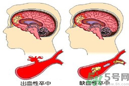 腦出血的治療方法是什么？腦出血可以用哪些藥物治療？