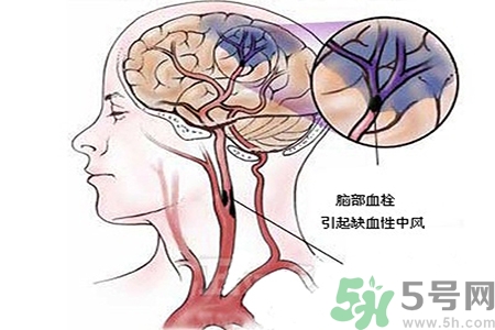 腦出血的治療方法是什么？腦出血可以用哪些藥物治療？