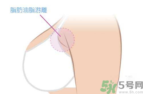 副乳是什么？副乳的危害