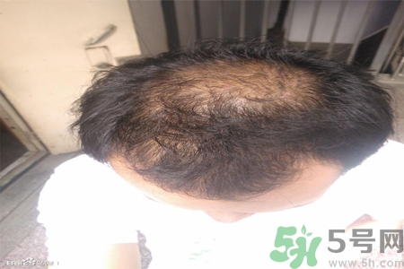 脫發(fā)的措施有什么？脫發(fā)的注意飲食有哪些？