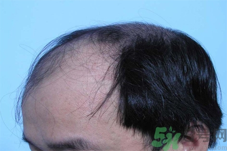 脫發(fā)的措施有什么？脫發(fā)的注意飲食有哪些？