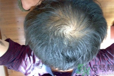 脫發(fā)的高發(fā)人群有哪些？如何預(yù)防脫發(fā)？