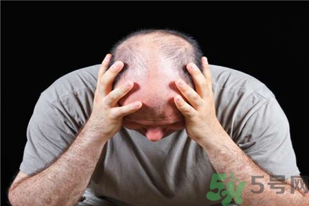 脫發(fā)的高發(fā)人群有哪些？如何預(yù)防脫發(fā)？