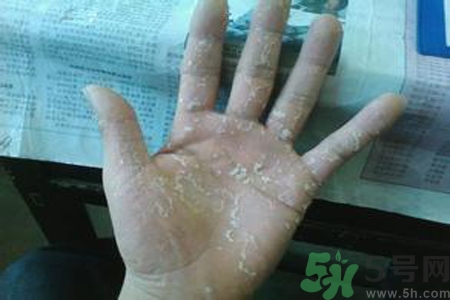 引起手足癬的主要原因？手足癬會引發(fā)什么疾??？