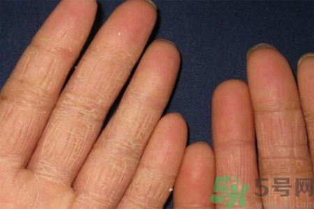 手足癬的治療方法？治療手足癬可以用什么藥？