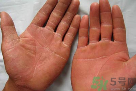 手足癬的治療方法？治療手足癬可以用什么藥？