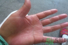 手足癬的易發(fā)人群有哪些？如何預(yù)防手足癬？