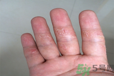 手足癬的易發(fā)人群有哪些？如何預(yù)防手足癬？
