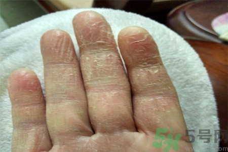 手足癬會傳染嗎？手足癬的傳播途徑有哪些？