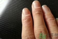 手足癬會傳染嗎？手足癬的傳播途徑有哪些？
