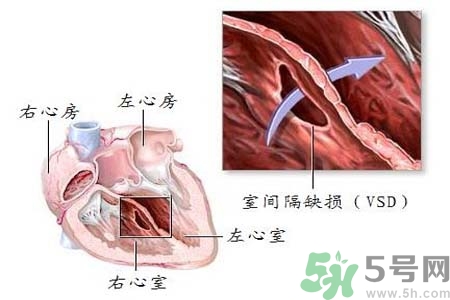 先天性心臟病是什么？先天性心臟病的癥狀有哪些？