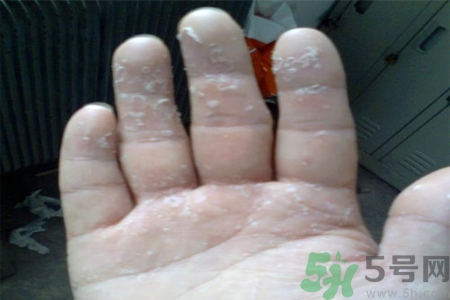 手足癬的易發(fā)人群有哪些？如何預(yù)防手足癬？