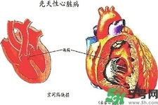 心臟病的癥狀是什么？心臟病的種類有哪些？