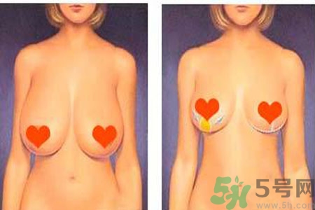 ?女性乳房下垂的原因是什么？女性乳房下垂的分類有哪些？