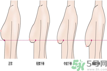 ?女性乳房下垂的原因是什么？女性乳房下垂的分類有哪些？