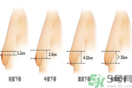 ?女性乳房下垂的原因是什么？女性乳房下垂的分類有哪些？