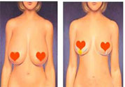 ?女性乳房下垂的原因是什么？女性乳房下垂的分類有哪些？