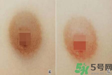 乳頭發(fā)黑怎么辦？怎么樣可以使乳頭變白？