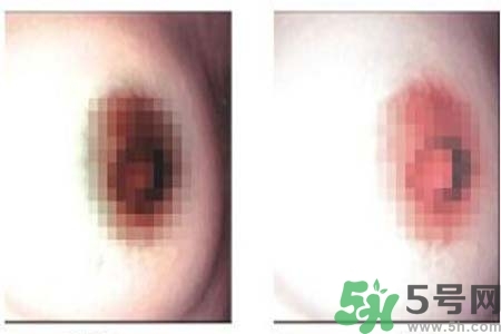 乳頭發(fā)黑怎么辦？怎么樣可以使乳頭變白？