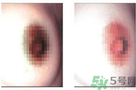 乳頭發(fā)黑是怎么回事？乳頭發(fā)黑是什么原因？