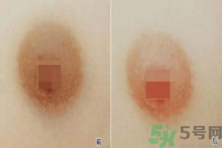 乳頭發(fā)黑是怎么回事？乳頭發(fā)黑是什么原因？