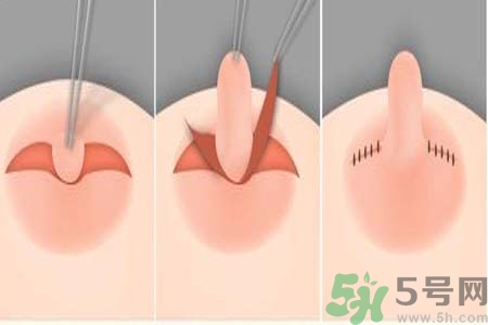 乳頭內(nèi)陷怎么回事？乳頭內(nèi)陷的原因是什么？