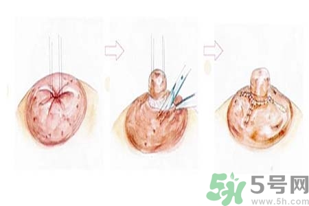 乳頭內(nèi)陷怎么回事？乳頭內(nèi)陷的原因是什么？