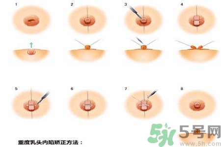 乳頭內(nèi)陷怎么回事？乳頭內(nèi)陷的原因是什么？
