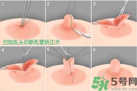 乳頭內(nèi)陷怎么辦？乳頭內(nèi)陷的癥狀有哪些？