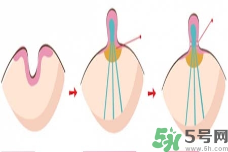 乳頭內(nèi)陷怎么辦？乳頭內(nèi)陷的癥狀有哪些？