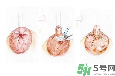 乳頭內(nèi)陷怎么辦？乳頭內(nèi)陷的癥狀有哪些？
