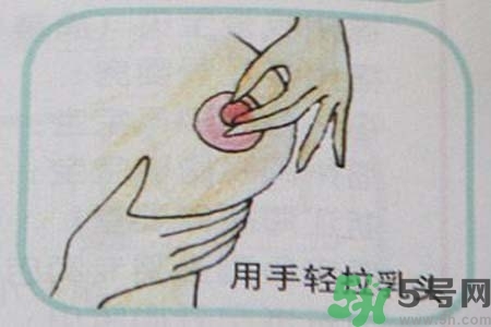 乳頭內(nèi)陷怎么辦？乳頭內(nèi)陷的癥狀有哪些？