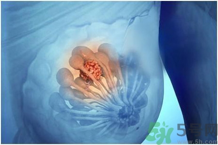 乳房屋硬塊有疼痛感怎么回事？乳房屋硬塊有疼痛感怎么辦？