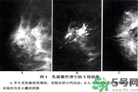 產(chǎn)生乳腺增生鈣化的病因是什么？乳腺增生怎樣治療？