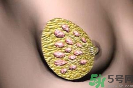 乳腺增生鈣化是什么？乳腺鈣化的癥狀有哪些？