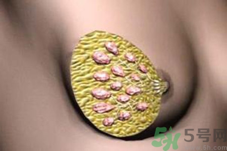 產(chǎn)生乳腺增生鈣化的病因是什么？乳腺增生怎樣治療？