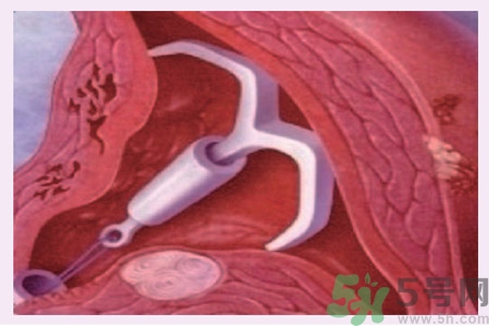 什么是宮內節(jié)育器？放置宮內節(jié)育器為什么能避孕？