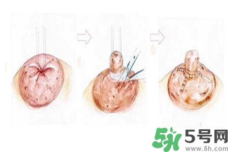 乳頭內(nèi)陷怎么矯正？乳頭內(nèi)陷矯正方法是什么？