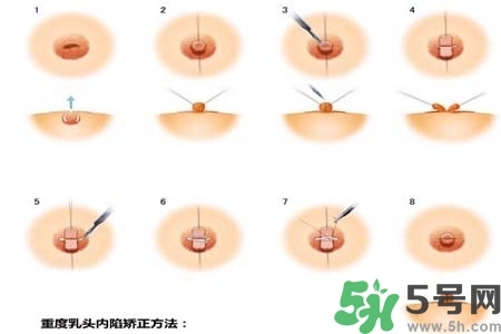 乳頭內(nèi)陷怎么矯正？乳頭內(nèi)陷矯正方法是什么？