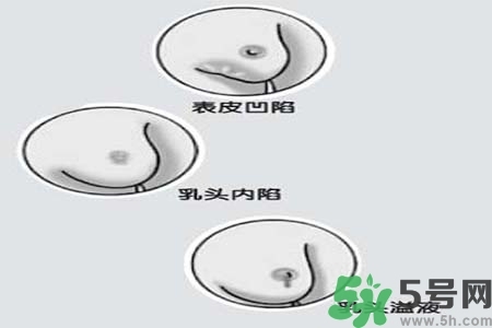 乳頭內(nèi)陷怎么矯正？乳頭內(nèi)陷矯正方法是什么？