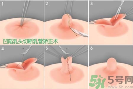 乳頭內(nèi)陷怎么矯正？乳頭內(nèi)陷矯正方法是什么？