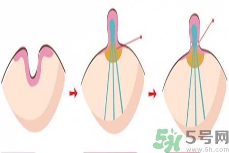 乳頭內(nèi)陷矯正需注意什么？乳頭內(nèi)陷如何預(yù)防？