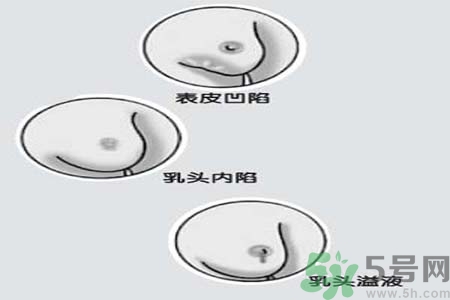 乳頭內(nèi)陷矯正需注意什么？乳頭內(nèi)陷如何預(yù)防？