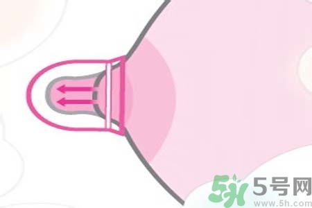 乳頭內(nèi)陷可以拔罐嗎？乳頭內(nèi)陷需要手術(shù)治療嗎？