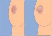 乳頭內(nèi)陷可以用吸奶器嗎？乳頭內(nèi)陷能不能用吸奶器？