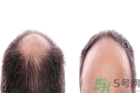 頭發(fā)稀少的原因是什么？如何預(yù)防禿頂?shù)陌l(fā)生？